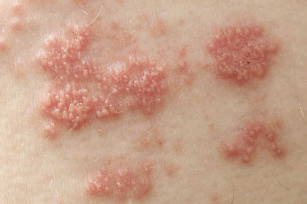 Best CBD for Shingles